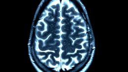 Normal Healthy Brain MRI Scan