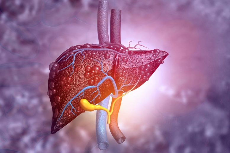 Nuclear Magnetic Resonance to Detect Fatty Liver Disease