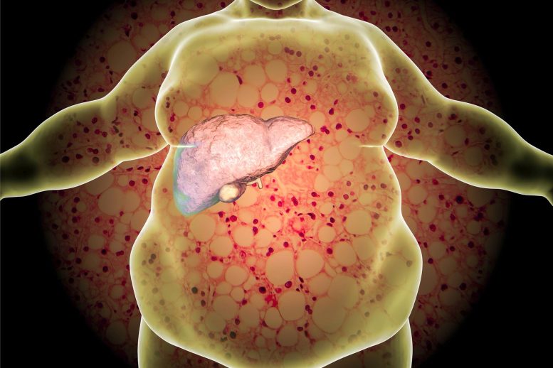 Obese Person Fatty Liver Disease