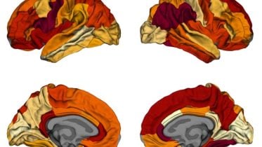 Obesity-Related Brain Neurodegeneration