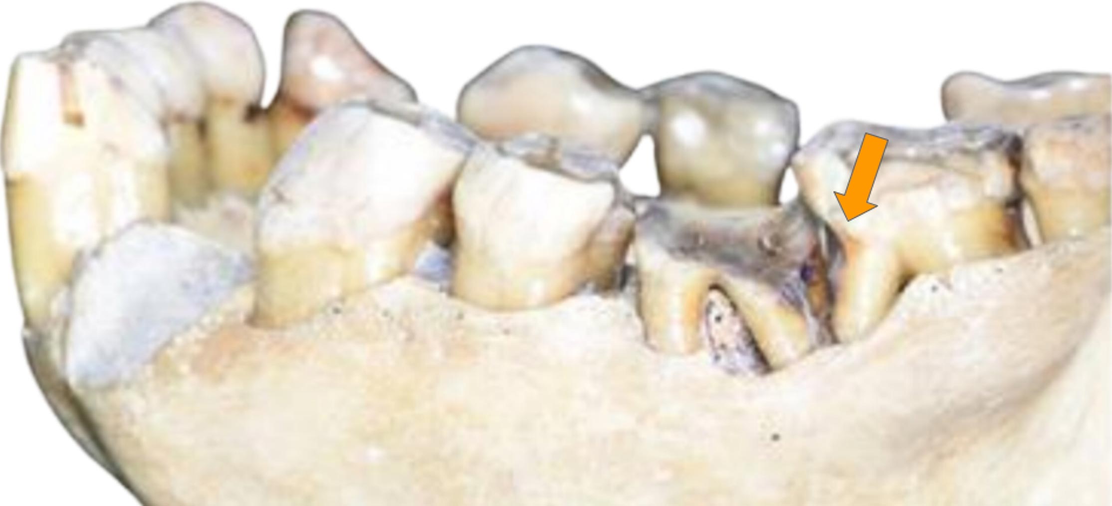 Orangutan Molar Showing Toothpick Groove