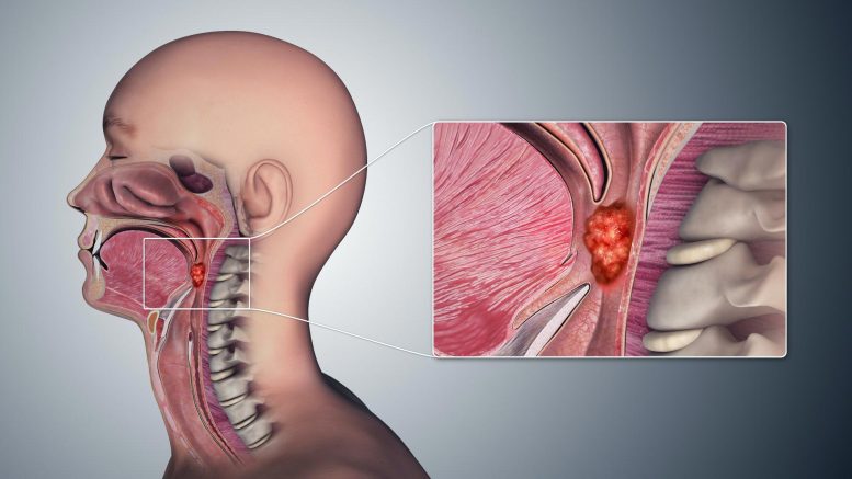 Oropharyngeal Cancer Throat