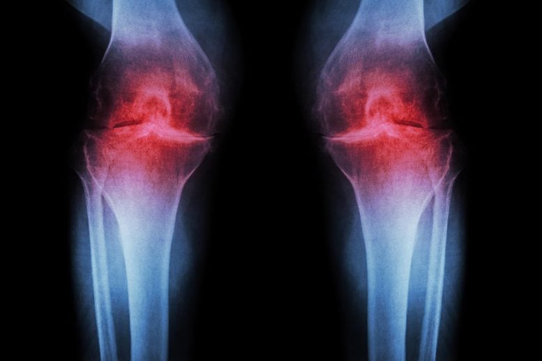 7-Year Study Reveals Rheumatoid Arthritis Begins Long Before Symptoms