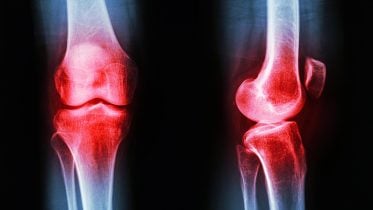 Osteoarthritis Knee Inflammation