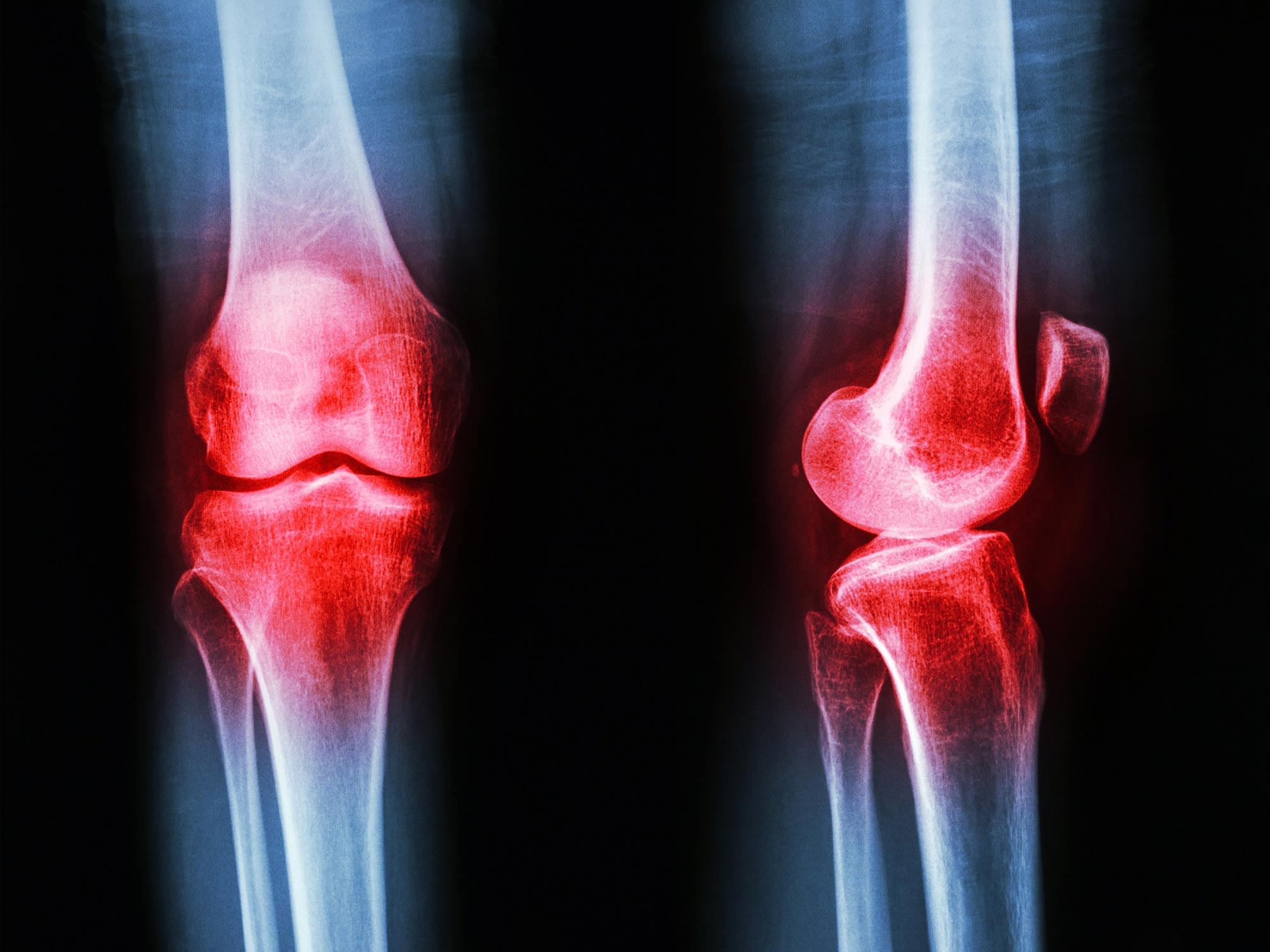 Common Arthritis Treatment May Actually Accelerate Disease Progression