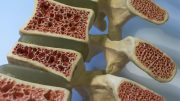 Osteoporosis Anatomy