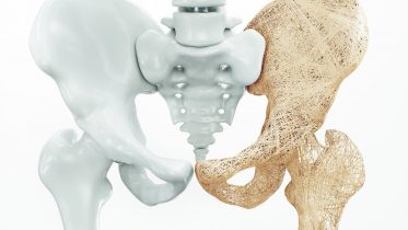 Osteoporosis Artist Rendering