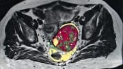 Ovarian Cancer MRI