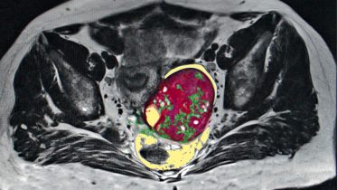 Ovarian Cancer MRI