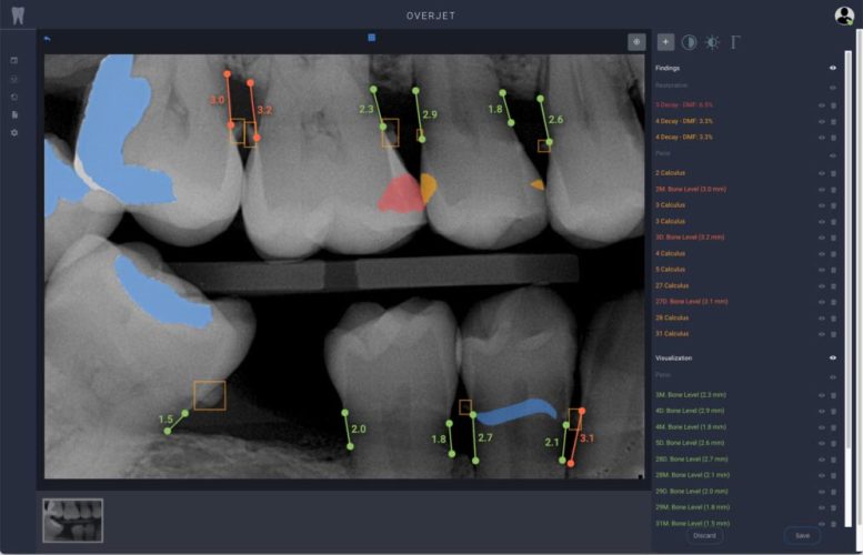 Overjet’s Software Analyzes and Annotates Dental X-Rays