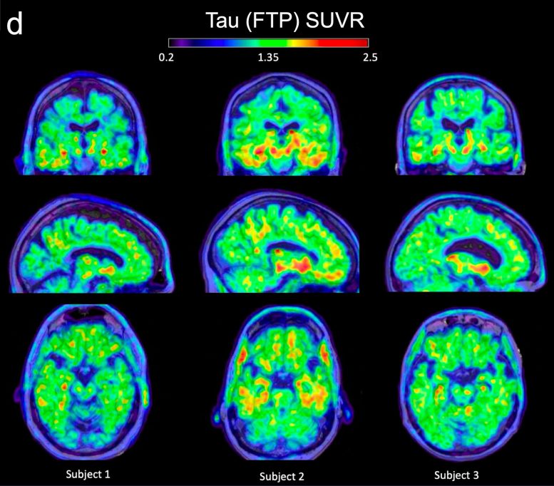 PET Scans Showing Tau Buildup in Older Brains