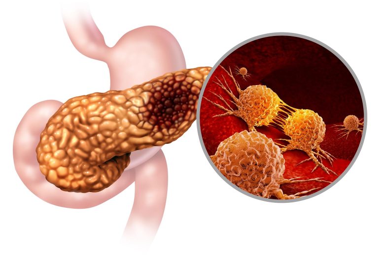 Pancreatic Cancer Anatomy