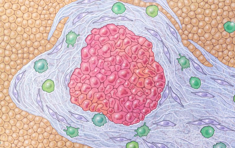 Pancreatic Cancer Cells Surrounded by a Dense Fibrotic Shield Made of Activated Fibroblasts and Connective Tissue