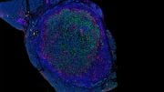 Pancreatic Cancer Tumor T Cells