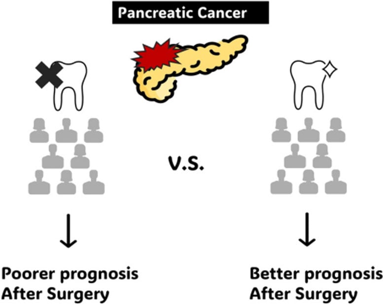 Pancreatic Cancer and Tooth Count