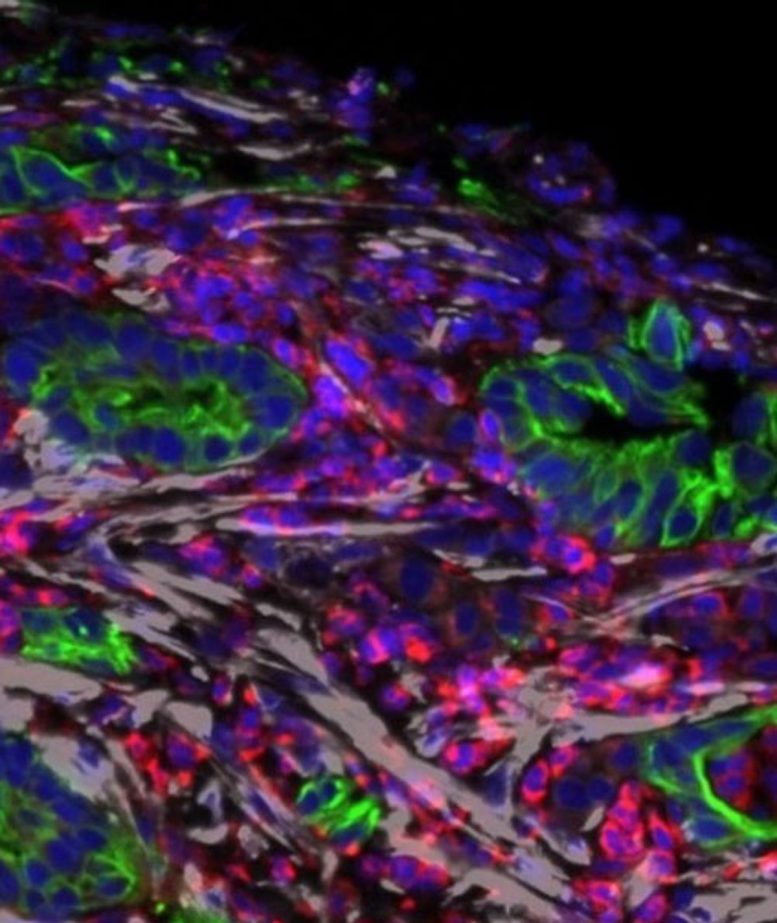 Pancreatic Tumor Microscopy