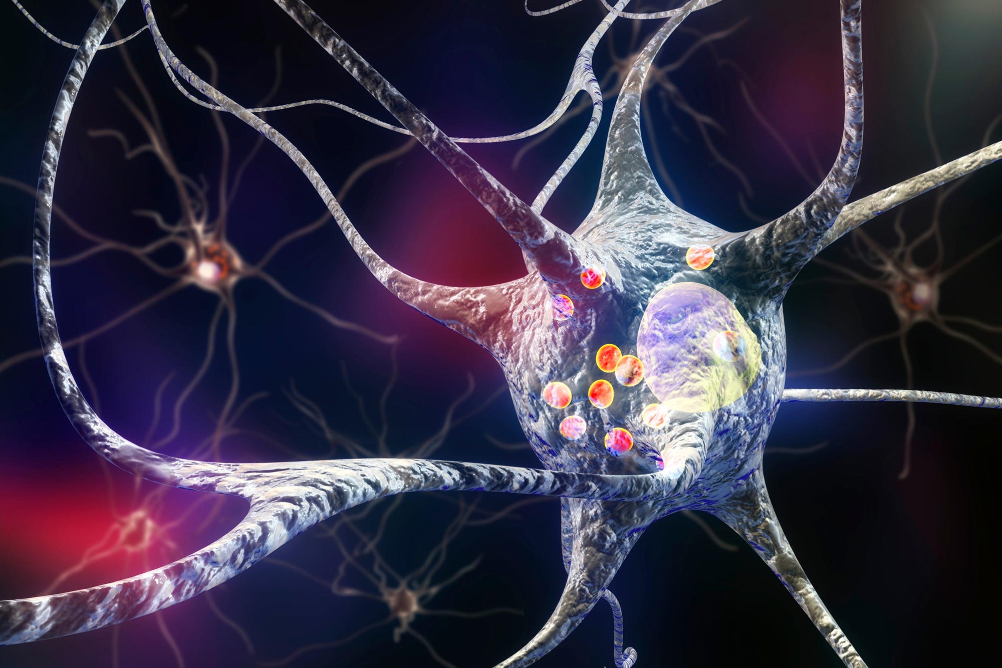celulele nervoase ale bolii Parkinson