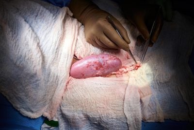 Porcine Kidney After Xenotransplantation