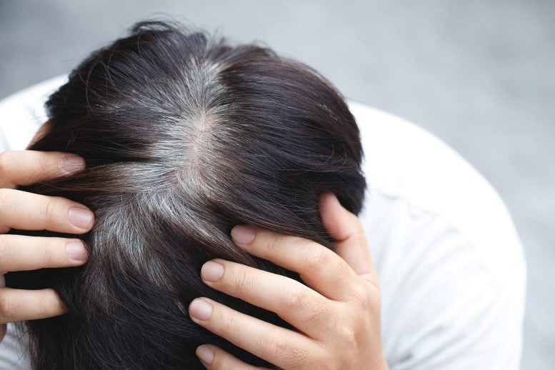 Premature Gray Hair