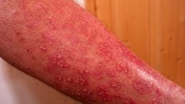 Psoriasis Skin Disease