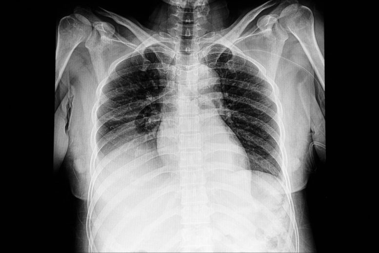 Pulmonary Edema Chest X-Ray
