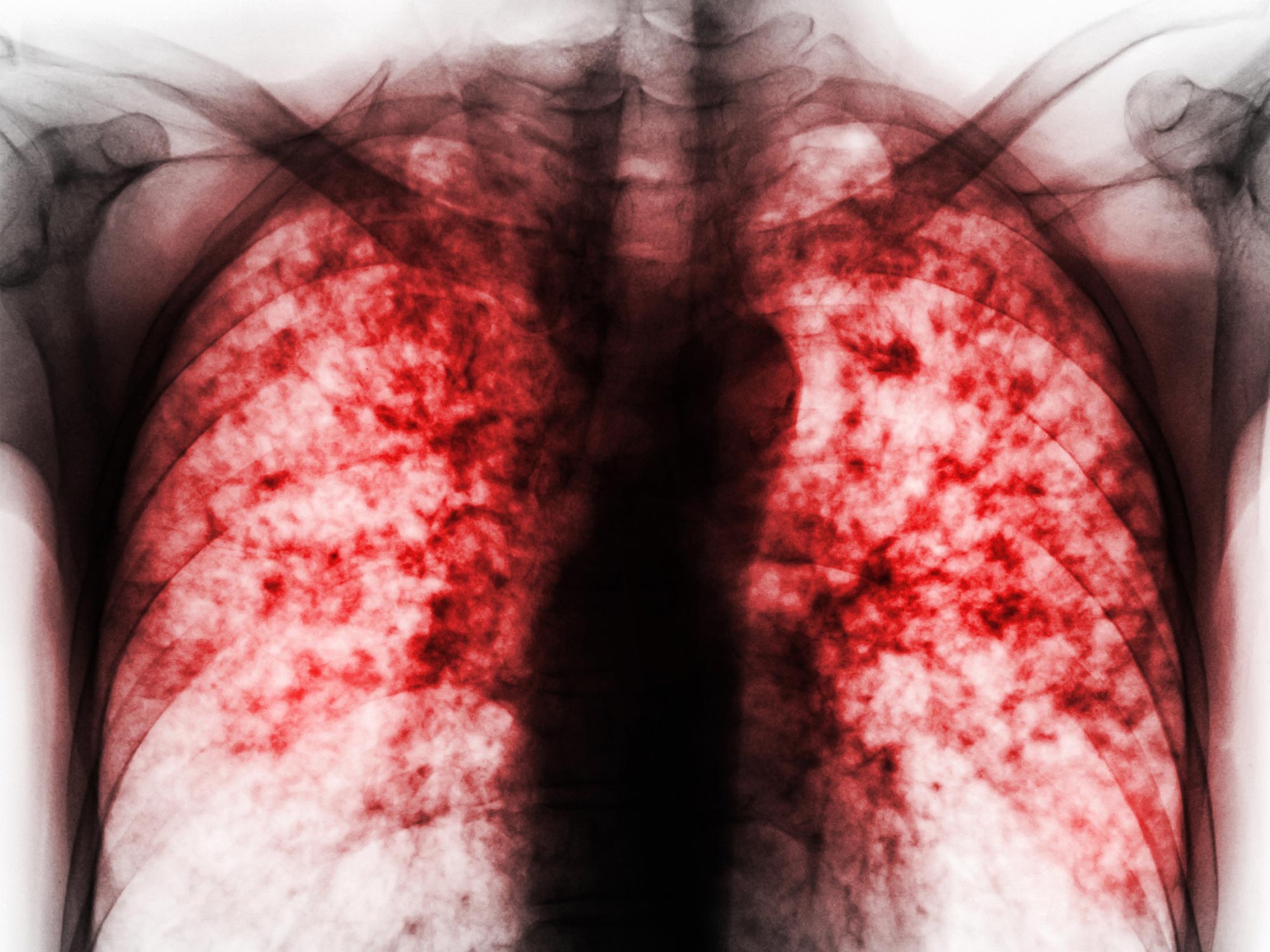 Groundbreaking New Compound Could Treat the World’s Deadliest Infectious Disease