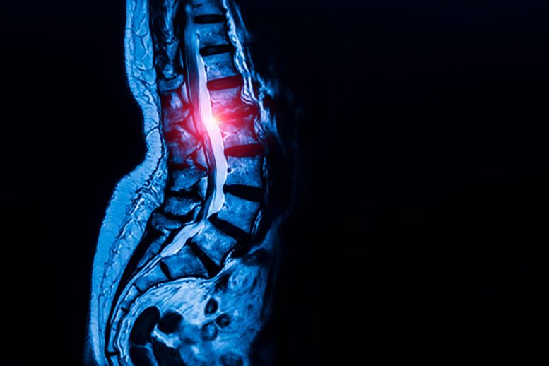 Researchers Discover What May Be Fueling One of the World’s Most Common Spine Disorders