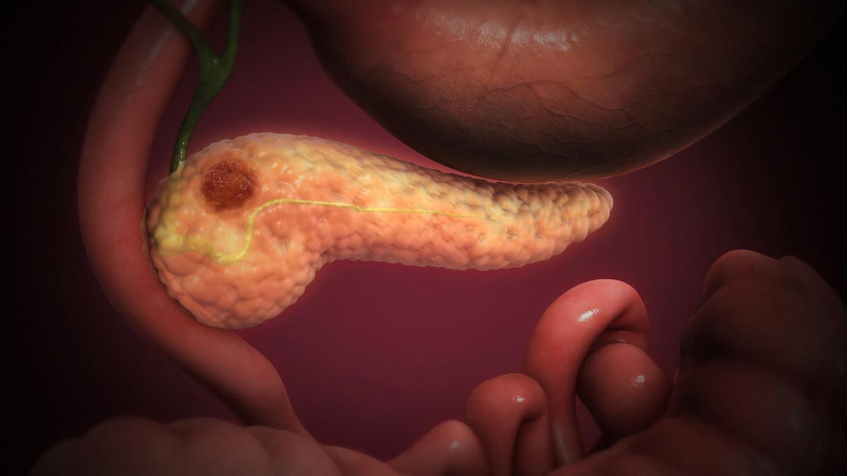 Why Pancreatic Cancer Is So Deadly: New Study Reveals Hidden Invasion Pathway - SciTechDaily