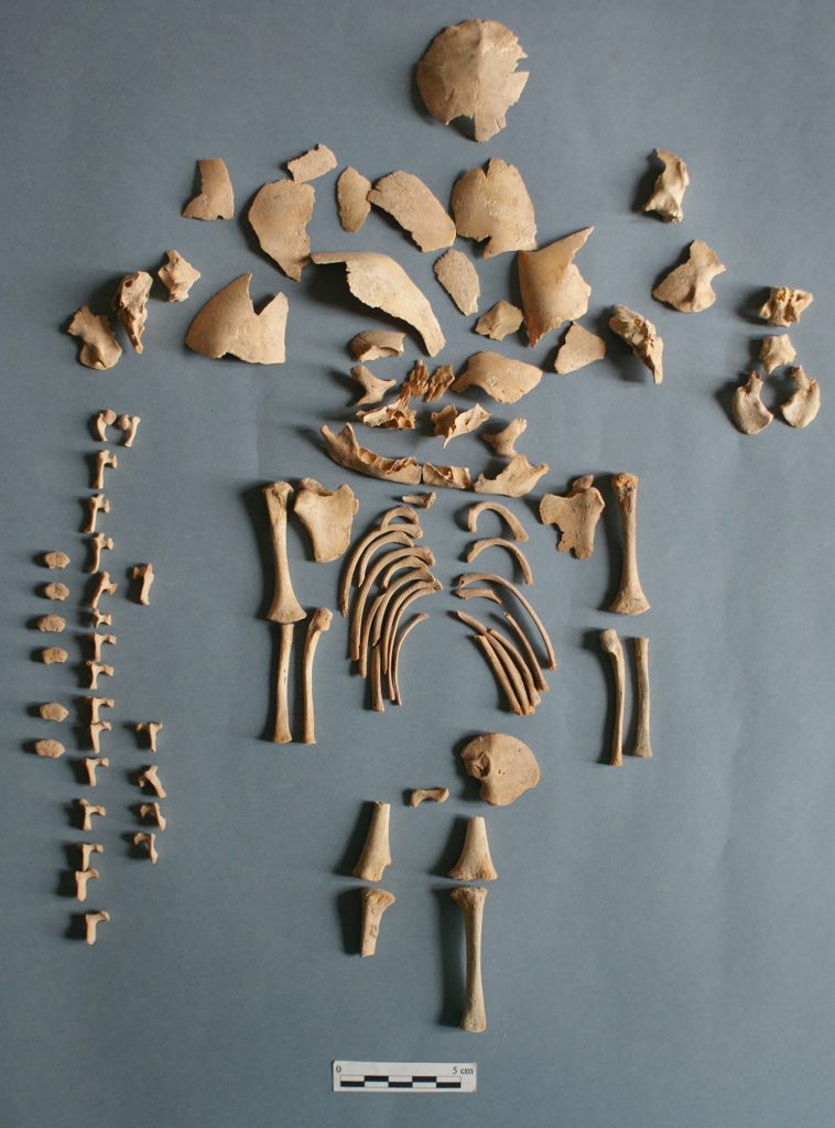 Remains of Individual CRU001 Who Had Down Syndrome