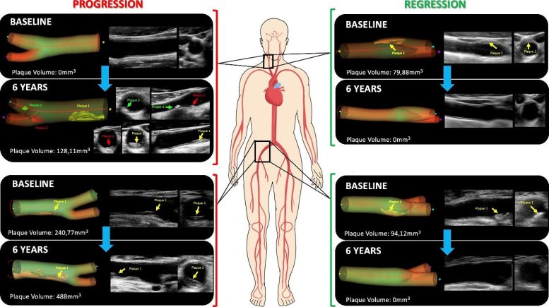 Representative Results From Participants Showing Atherosclerosis Progression and Regression in Arteries of the Neck and Groin