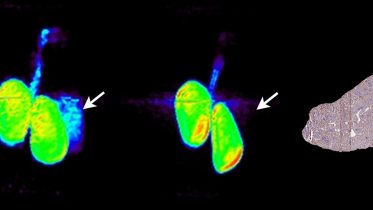 Researchers Develop New Approach to Personalized Cancer Treatment