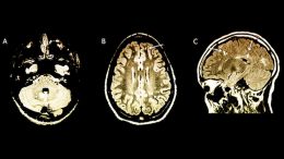 Researchers Discover MS Risk in Children Using MRI Brain Scans