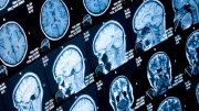 Researchers Identify Brainstem Changes in Parkinson’s Disease
