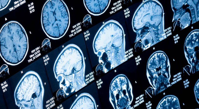Researchers Identify Brainstem Changes in Parkinson’s Disease
