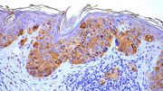Researchers Identify a New Treatment Target for Melanoma