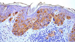 Researchers Identify a New Treatment Target for Melanoma