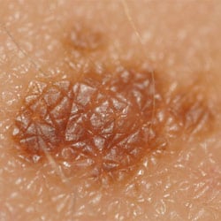 Researchers Identify the Scent of Melanoma