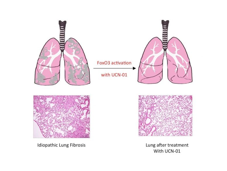 Researchers Reveal Cause of Pulmonary Fibrosis