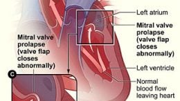 Researchers Reveal Gene for Mitral Valve Prolapse
