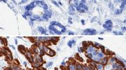 Researchers Uncover Cellular Basis for Age-related Breast Cancer Vulnerability