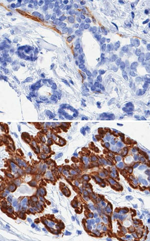 Researchers Uncover Cellular Basis for Age-related Breast Cancer Vulnerability