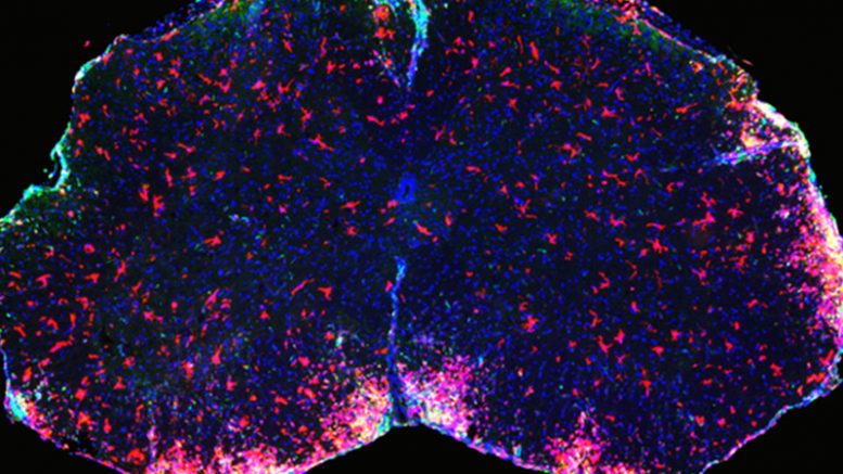 A Promising New Treatment For Multiple Sclerosis