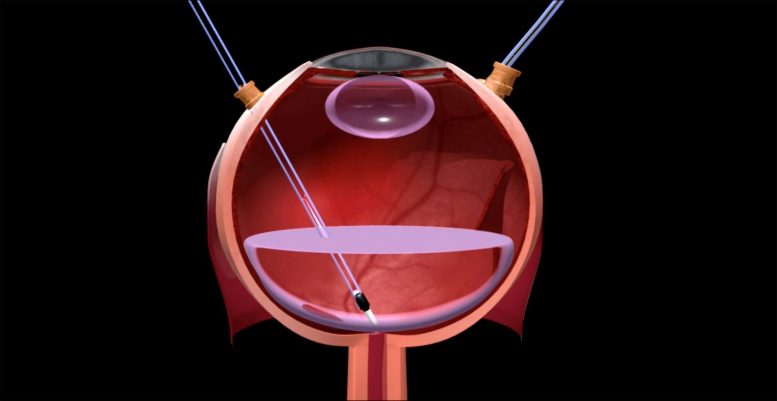 Retina Reattach With Perfluoro Decalin