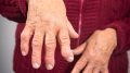 Rheumatoid Arthritis Hands