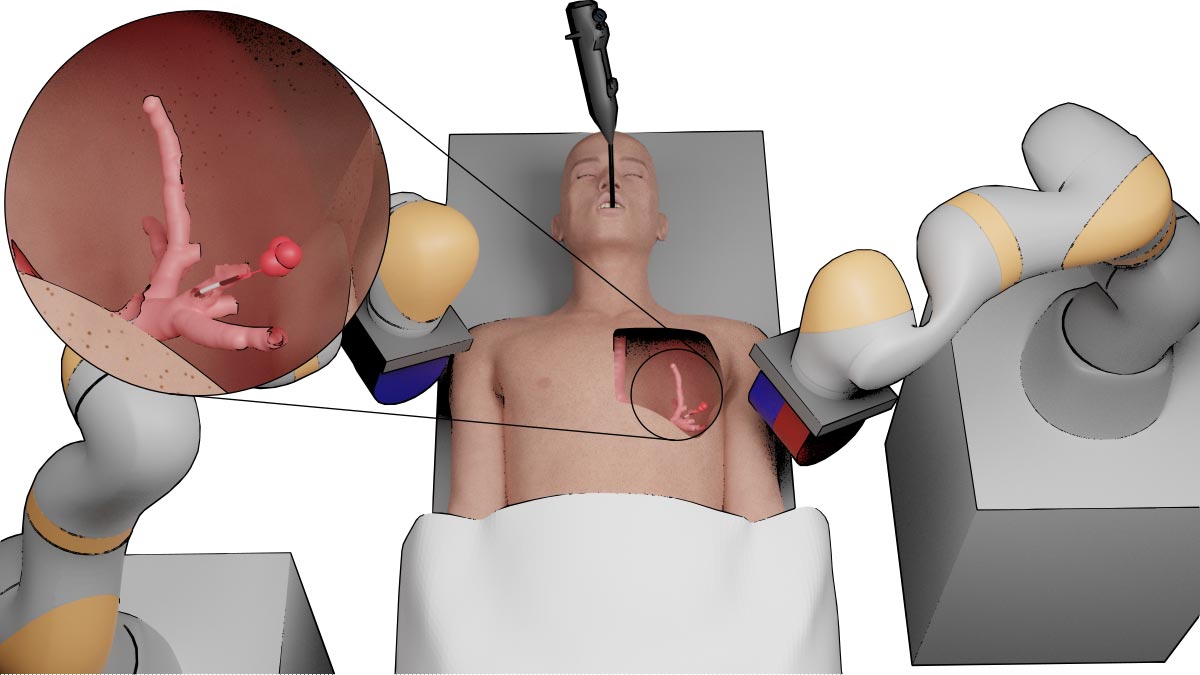 Robotic Platform for Peripheral Lung Tumor Intervention Based on Magnetic Tentacles