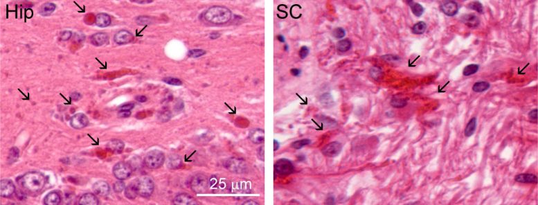 Rosenthal Fibers in Alexander Disease Brain Tissue