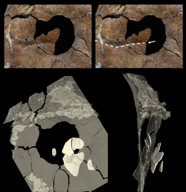 Scapula Perforation and Embedded Bone Fragments