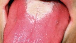 Scarlet Fever Strawberry Tongue