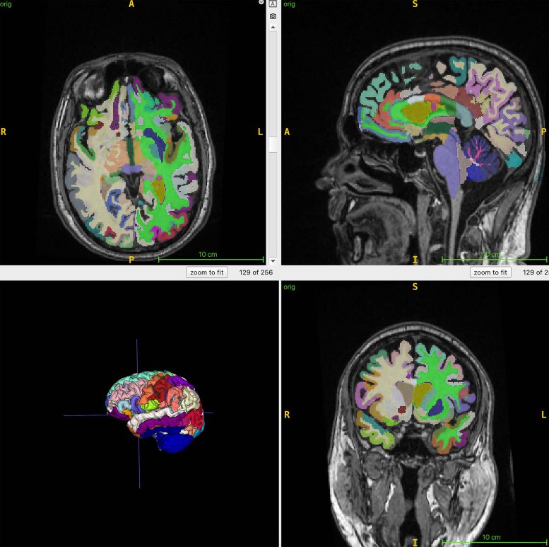 Segmented Regional Volumes 3D T1 Volumetric MRI Brain Scans