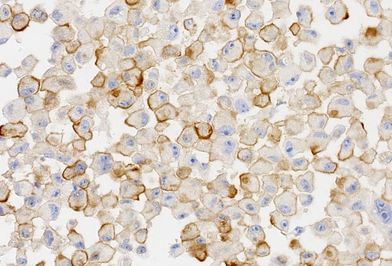 Senescent Human Melanoma Tumor Cells